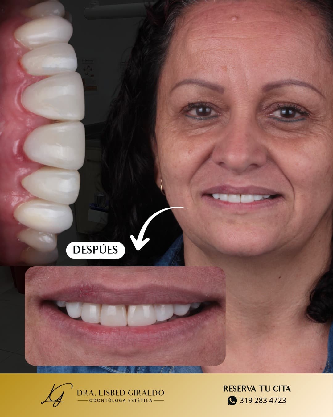 Antes y después de un diseño de sonrisa: primer plano de las carillas y la paciente sonriendo con el resultado final