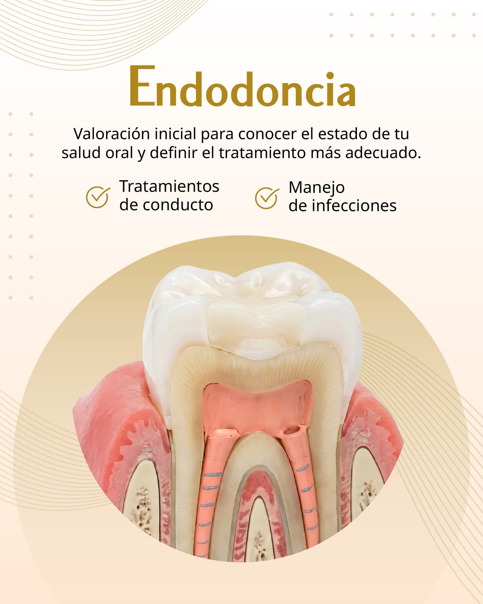 Endodoncia — Tratamos el interior del diente para salvarlo y eliminar la infección.